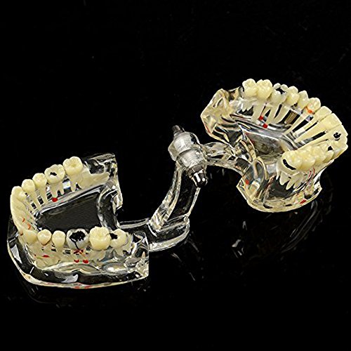 Dentista Angzhili Padrão Patrônica Patológica Implante Dentário Dentes Adultos Modelo de Ferramentas de